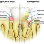Periodontal disease